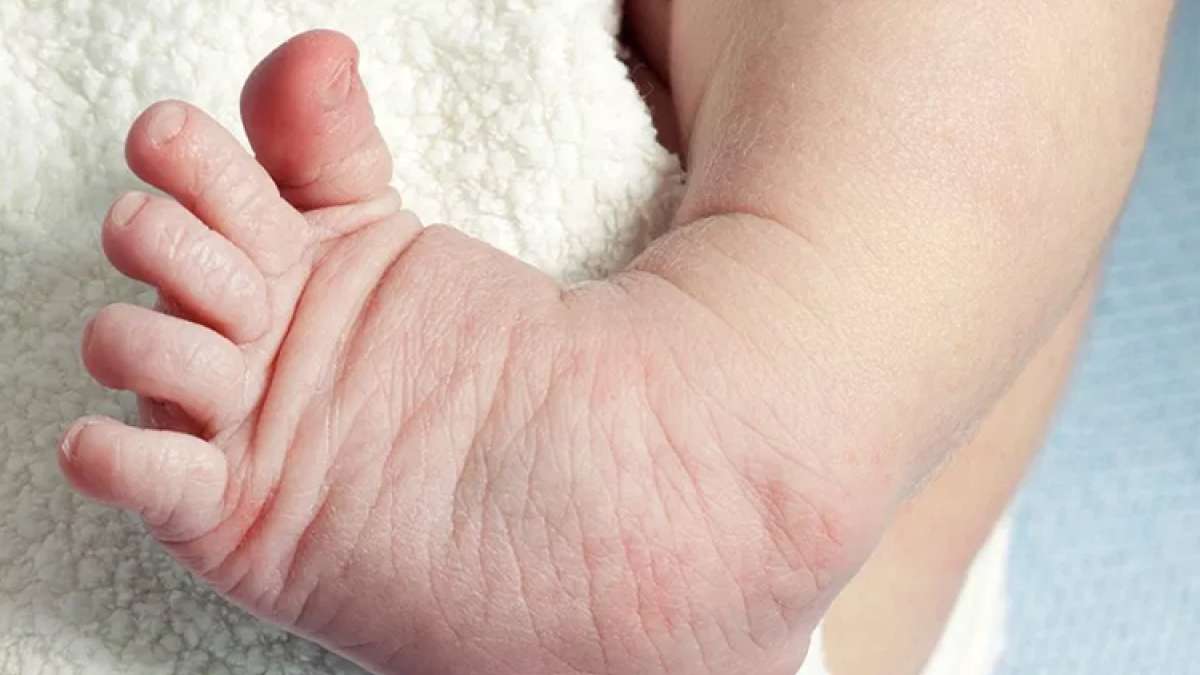 Clubfoot Symptoms And Causes द ड प ए ग क लब फ ट ब म र स प ड त बच च इस तरह करव ए इल ज India Tv Hindi