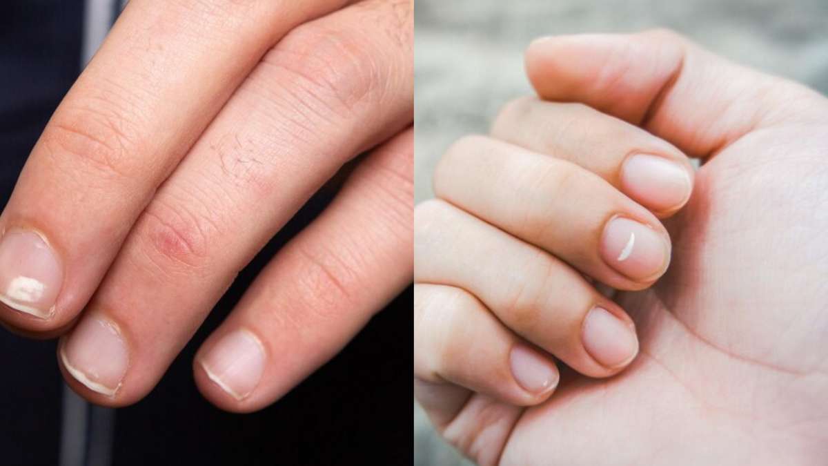White Spots on the Nails tell five things about your health - India TV Hindi