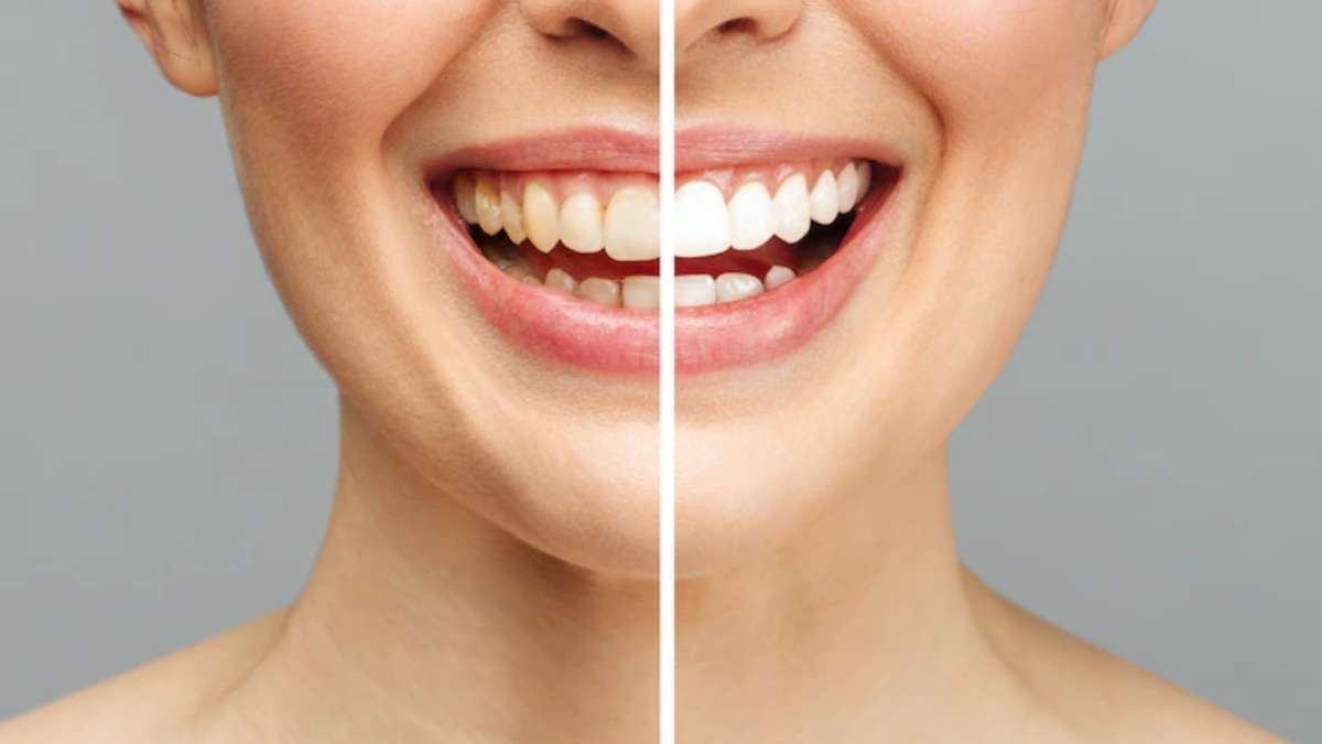 इन 3 घरेलू उपायों को अपनाने से आपके दांतों का पीलापन होगा मिनटों में दूर