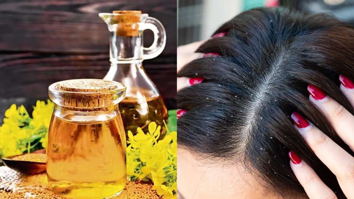 डैंड्रफ कैसे दूर करें: सरसों तेल में मिला कर बालों में लगाएं ये 1 चीज |  Mustard oil with lemon for hair dandruff in hindi - India TV Hindi