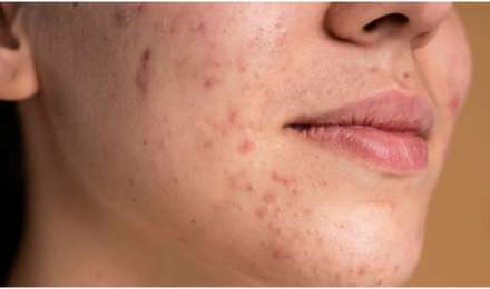 Skin Care: चेहरे के दाग-धब्बों से हैं परेशान? हल्दी का करें ऐसे इस्तेमाल और देखें कमाल