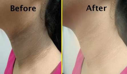 मिनटों में गायब होगा गर्दन का कालापन, बस अपनाकर देखें ये तरीका