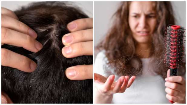 Fungal Infection on Scalp How to Treat It  By Dr Rekha Yadav  Lybrate