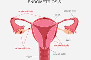 Understanding Endometriosis In Hindi Symptoms Causes Stage And Treatment आख र मह ल ओ क सबस ज य द क य ह त ह ए ड म ट र य स स ब म र ज न लक षण क रण और इल ज India Tv