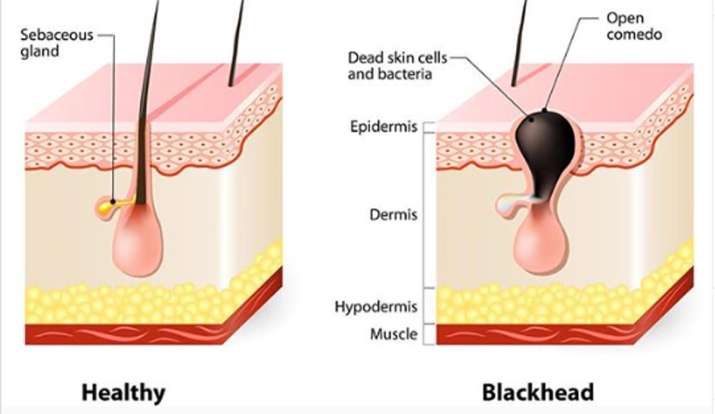 blackheads, home remedies for blackheads,blackheads cause