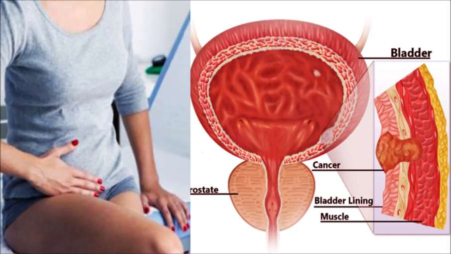 Bladder cancer causes treatment symptoms in hindi - India TV Hindi | page 2
