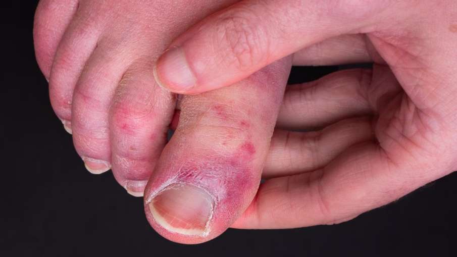 chilblains toes home remedies