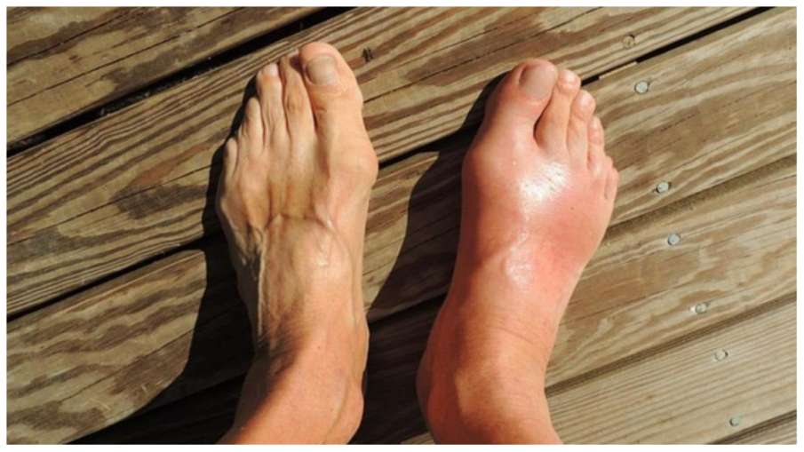 यूरिक एसिड में ग्रीन टी Is green tea good for uric acid in hindi