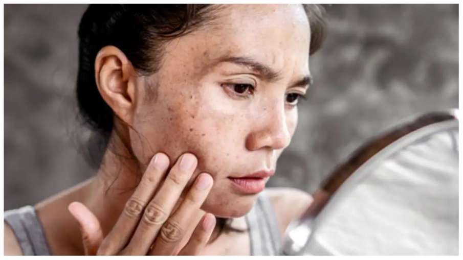 pigmentation