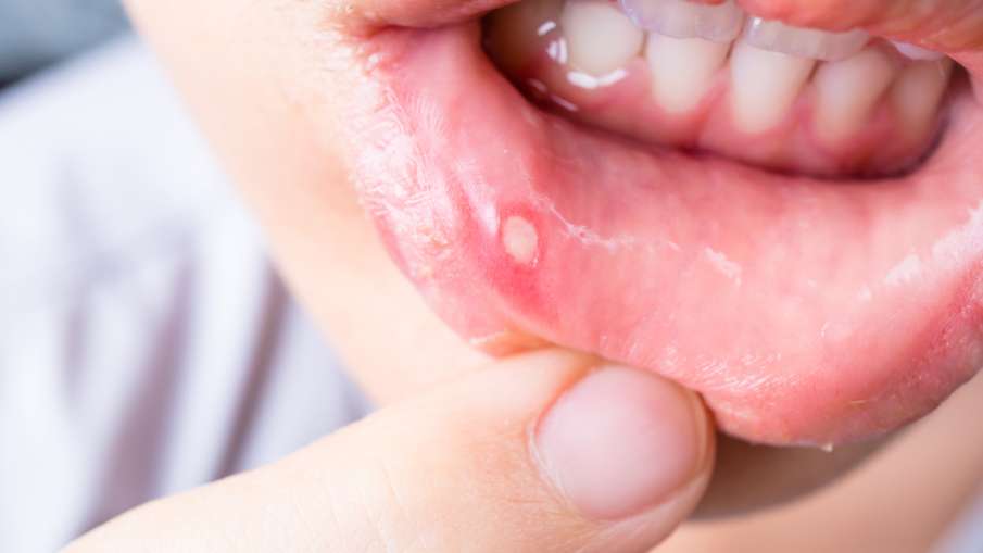 mouth_ulcer