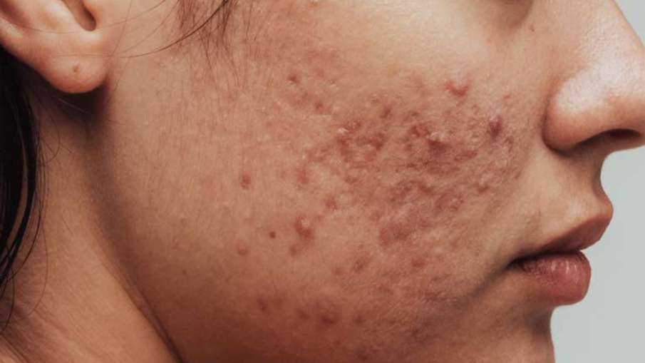 acne