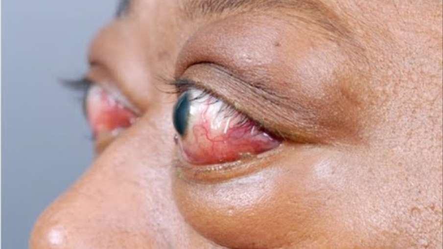 thyroid_eyes thyroid_eyes