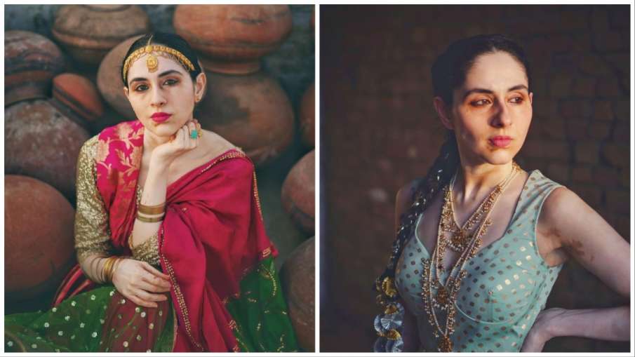 vitiligo models names