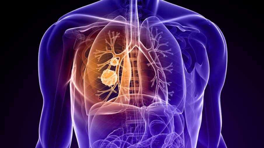  Lung Cancer