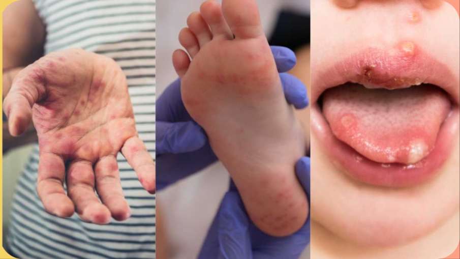  Hand foot and mouth disease in hindi