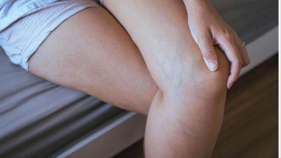 sudden prominent blue veins sudden prominent blue veins