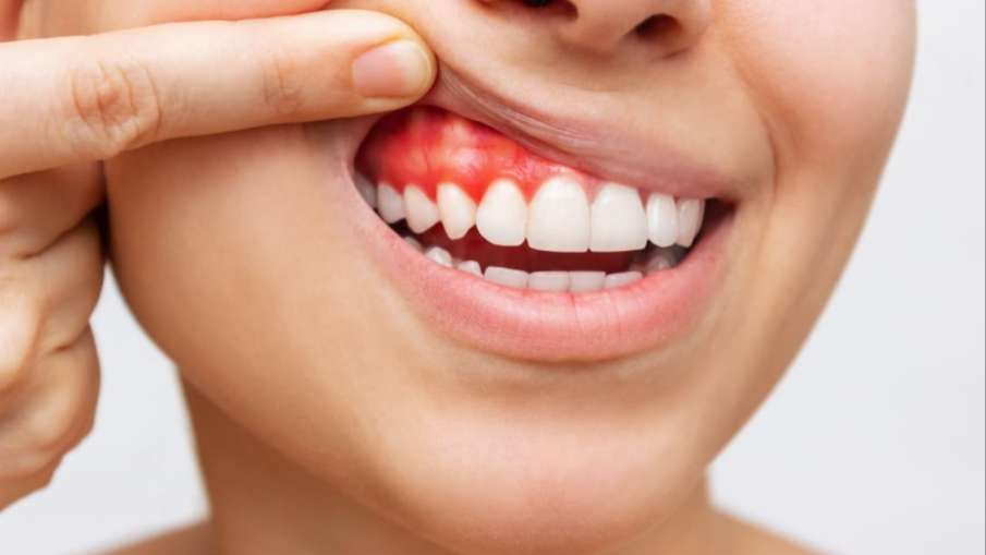 bleeding_gums