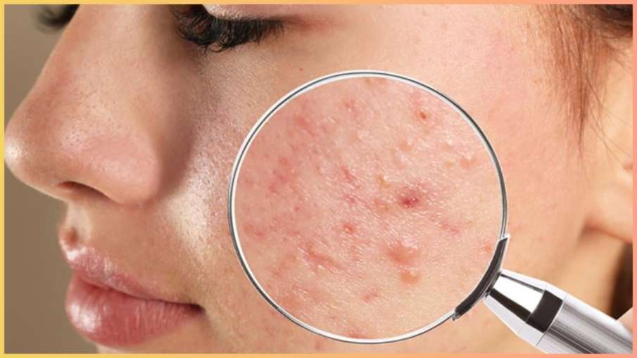 moisturizer can cause acne moisturizer can cause acne