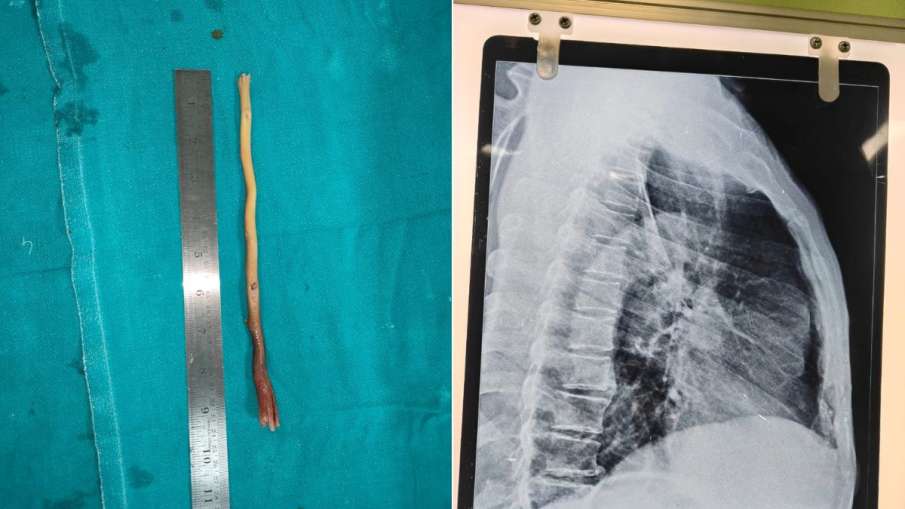 डॉक्टरों ने ऑपरेशन कर दातून को बाहर निकाला। डॉक्टरों ने ऑपरेशन कर दातून को बाहर निकाला।