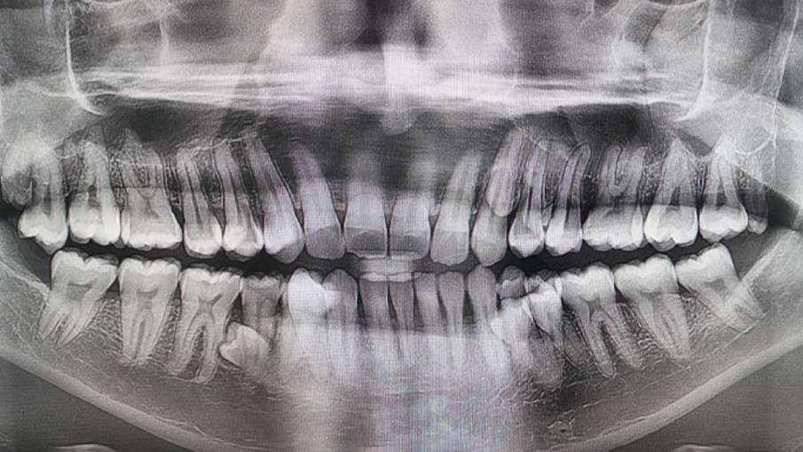 man with most teeth in the world, Prathab Muniandy record, Guinness World Records teeth