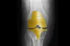 Golden Knee Implant- India TV Hindi
