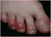 Swelling on feet- India TV Hindi