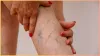 varicose veins- India TV Hindi