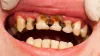 Teeth Cavity Home Remedies- India TV Hindi