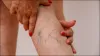 Varicose Veins- India TV Hindi