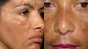 Melasma Causes And Treatment- India TV Hindi