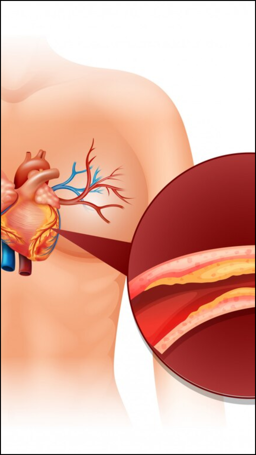 आर्टरीज में ब्लॉकेज के वार्निंग साइन, दिखते हैं ये लक्षण