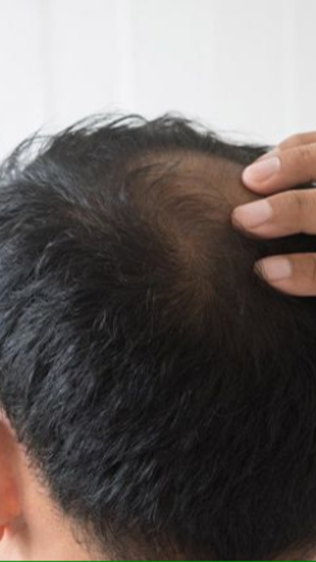 Hair Fall होने पर कौन से टेस्ट करवाने चाहिए? 