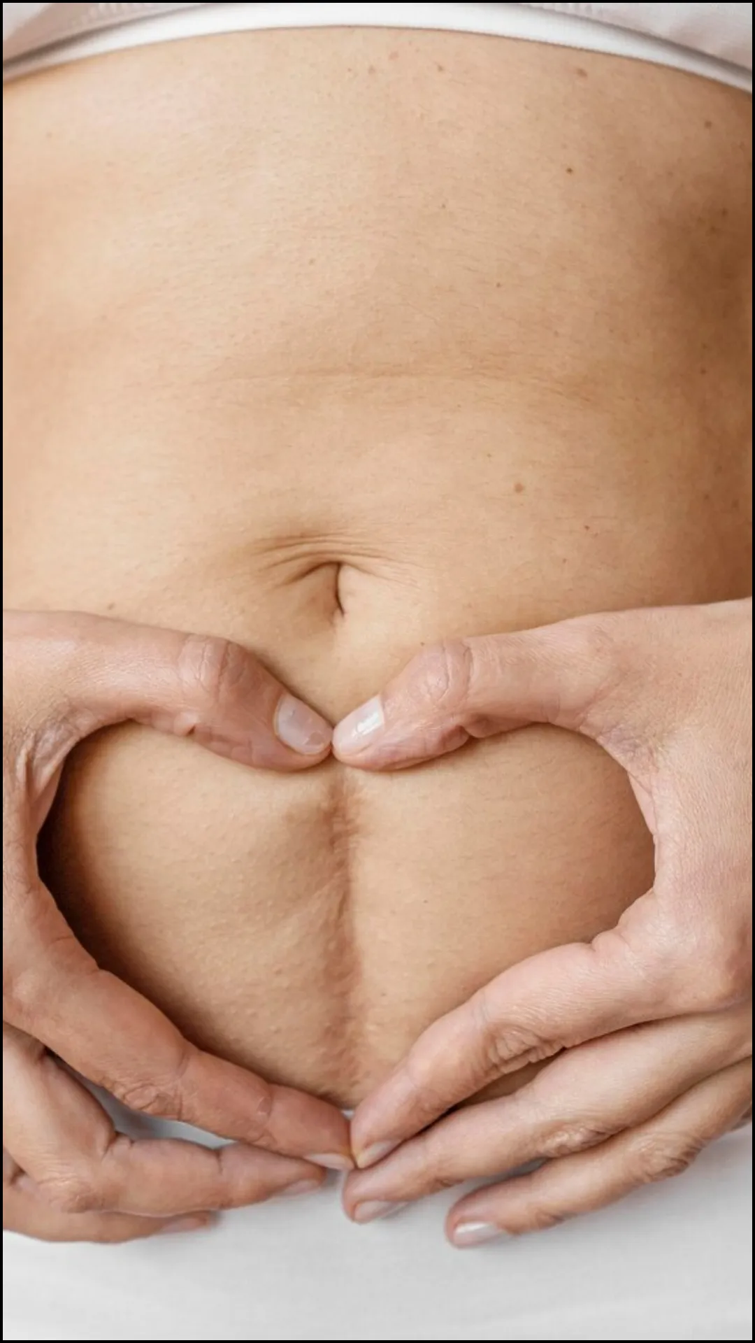 सिजेरियन डिलीवरी में कितने टांके आते हैं?