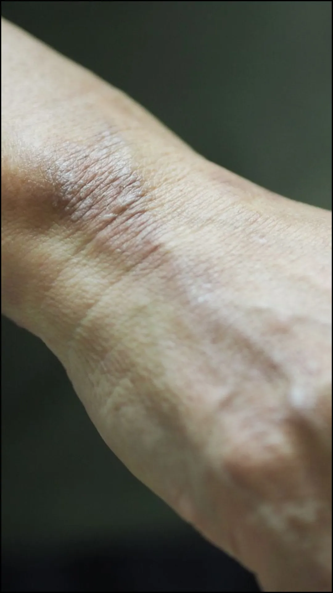 कुष्ठ रोग के क्या हैं लक्षण?