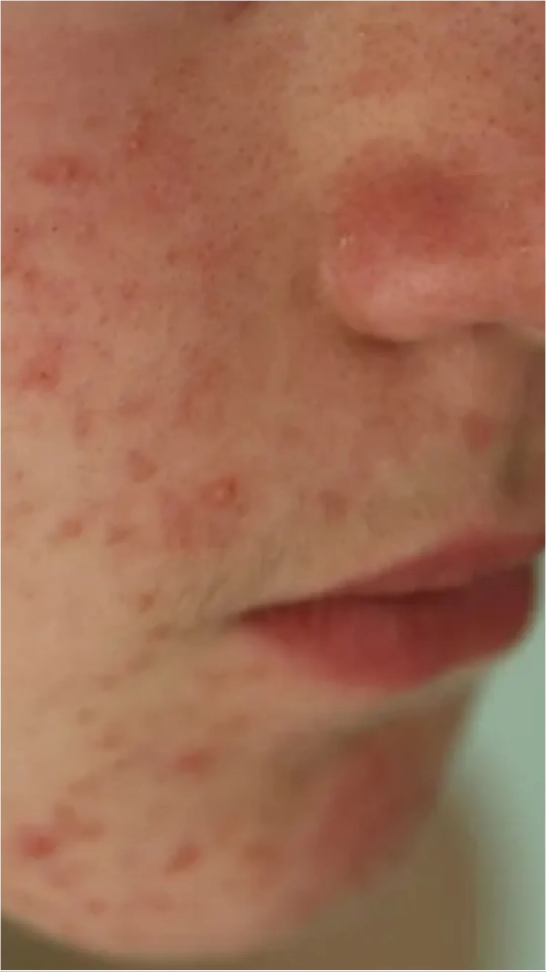 इस विटामिन की कमी से चेहरे पर आने लगते हैं मुहांसे 