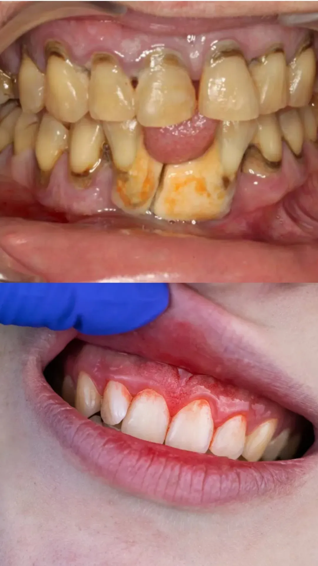 पायरिया रोग किस विटामिन की कमी से होता है? 