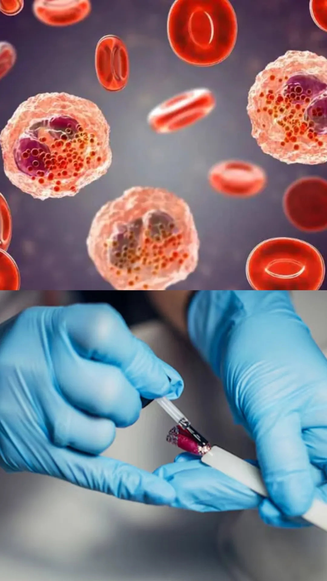 टीएलसी बढ़ने से कौन सी बीमारी होती है?