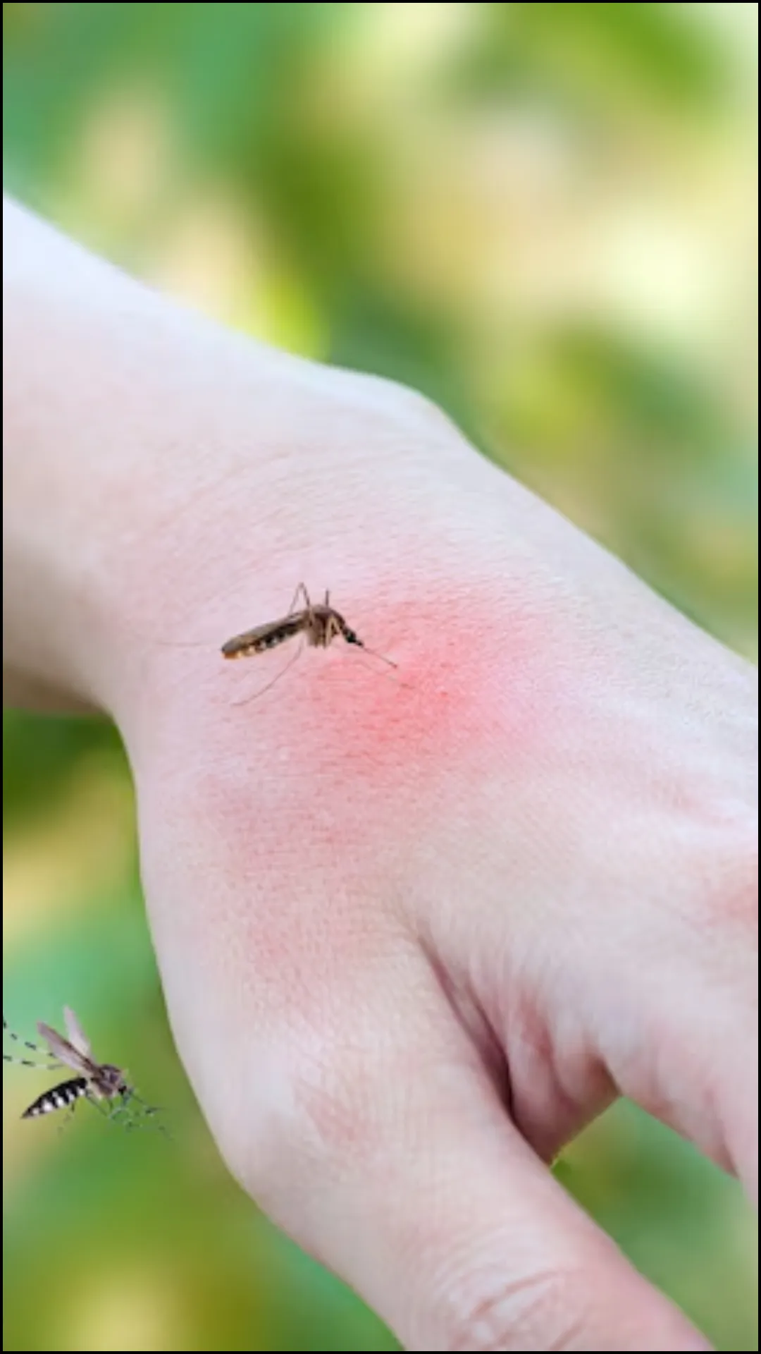 मच्छर काटने के निशान कैसे मिटाएं? 