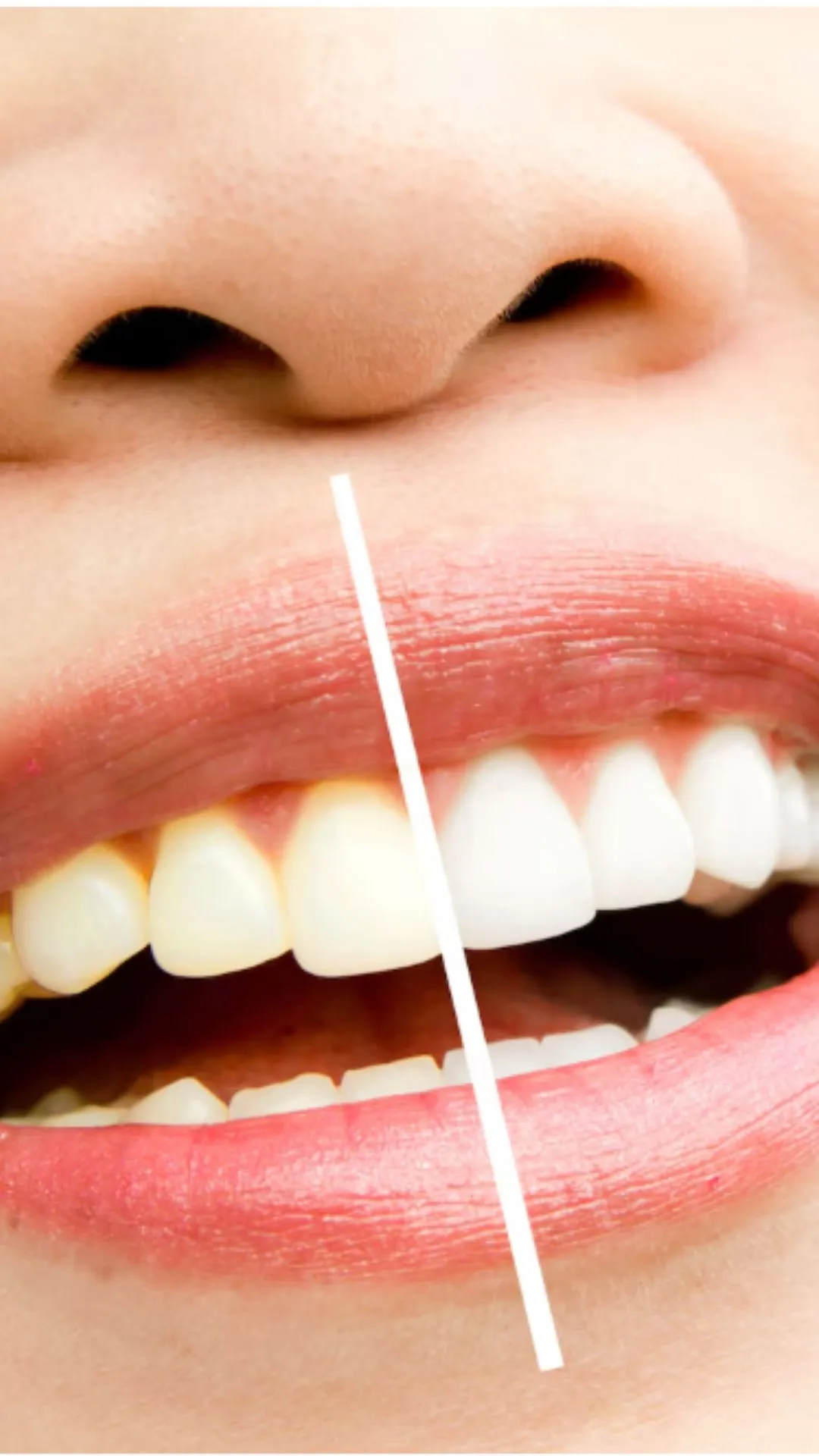 दांतों का पीलापन दूर करने के घरेलू नुस्खे, मोती से चमकेंगे Teeth