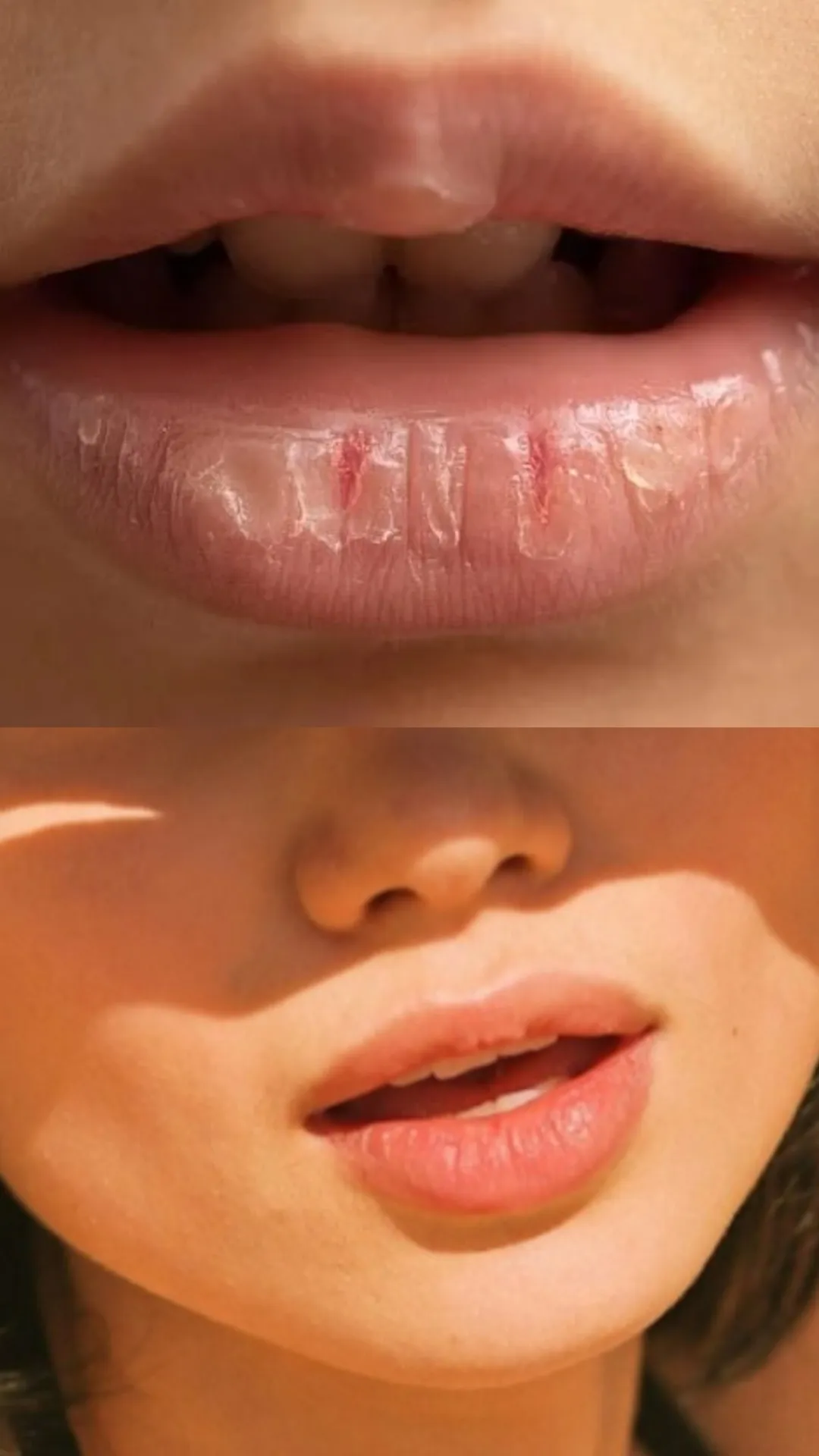 होंठों को फटने से कैसे बचाएं?