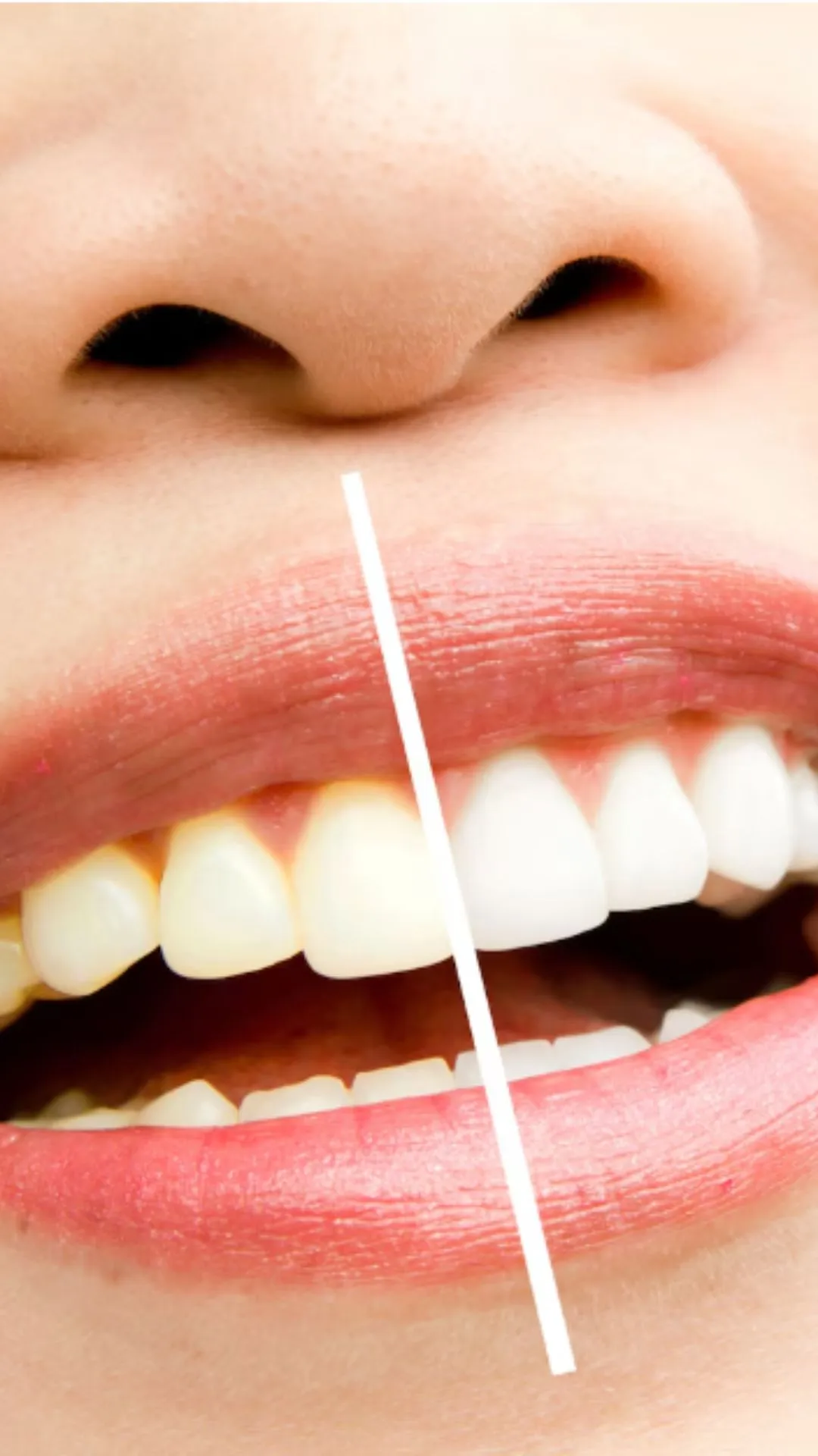 दांतों का पीलापन दूर करने के आसान घरेलू नुस्खे