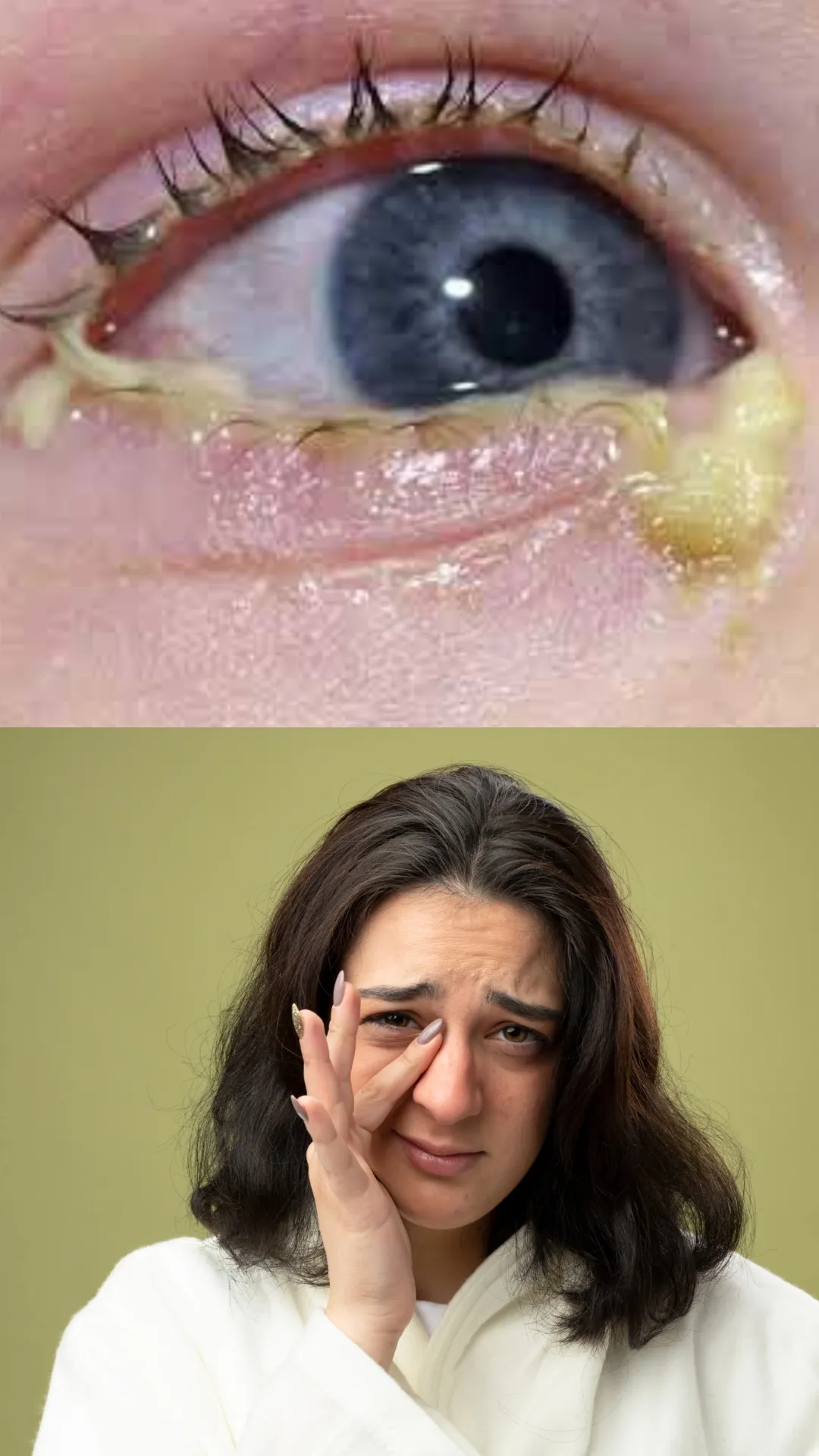 आंखों में कीचड़ क्यों आता है?