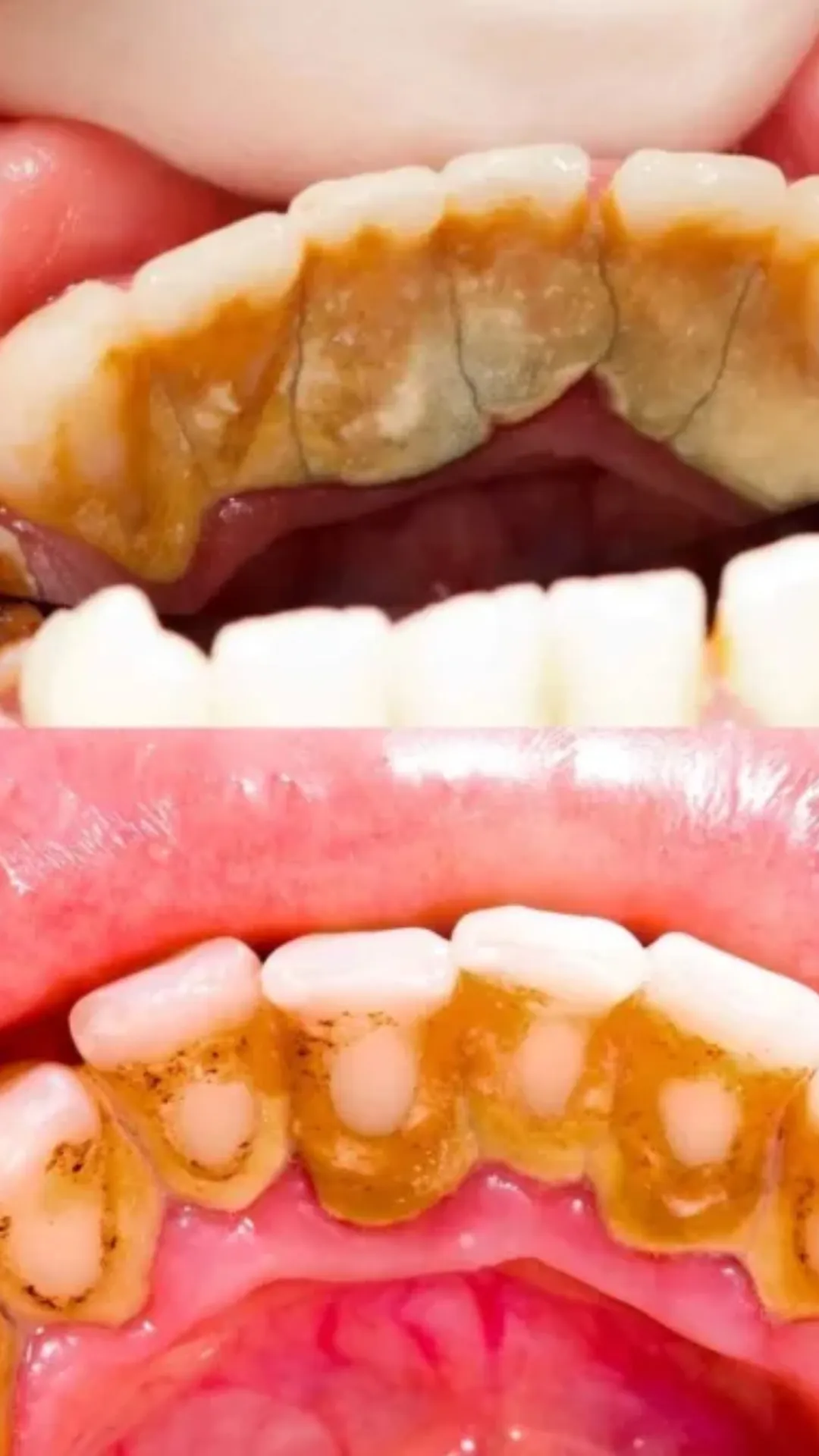 दांतों पर जमे ज़िद्दी प्लाक को कैसे हटाएं? 