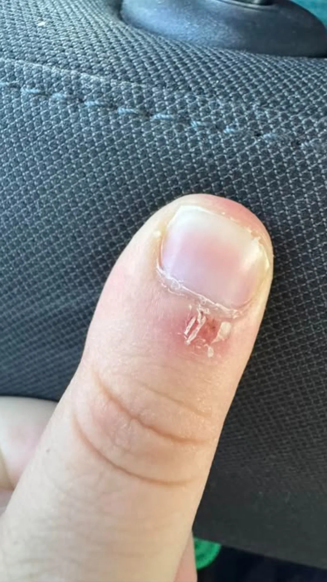 नाखूनों के किनारे की त्वचा किसकी कमी से निकलती है?