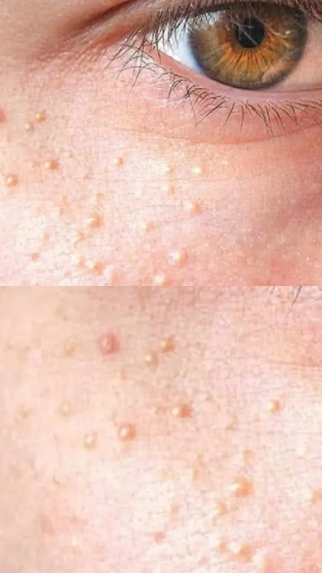 चेहरे से सफेद दाना कैसे हटाएं?