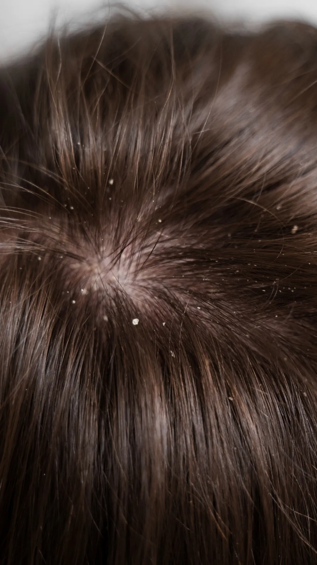 ठंड में क्या उपाय करें, जो बालों में डैंड्रफ न हो