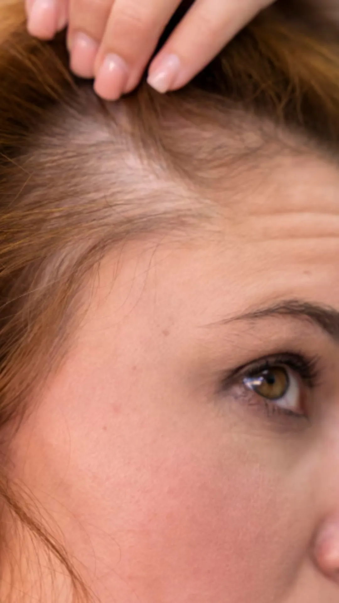 किस विटामिन की कमी से बाल झड़ते हैं?