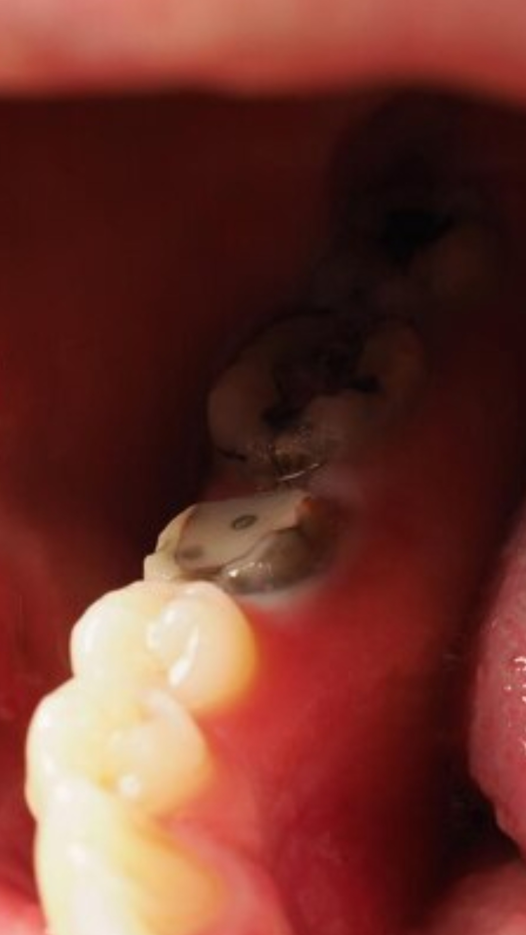 दांत में लगे कीड़ों, दर्द और सड़न से ऐसे पाएं छुटकारा