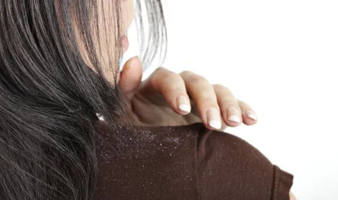 ड्रैंडफ से है परेशान, तो करें इन आर्गेनिक ऑय़ल का यूज dandruff- India TV Hindi