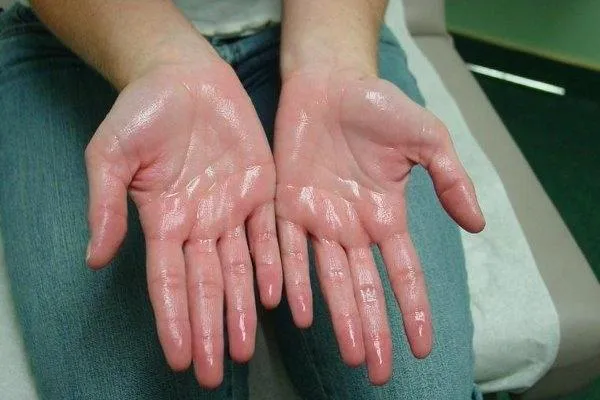 अगर आपके हाथ से निकलता है ज्यादा पसीना, तो आप है इस बीमारी के शिकार sweating- India TV Hindi